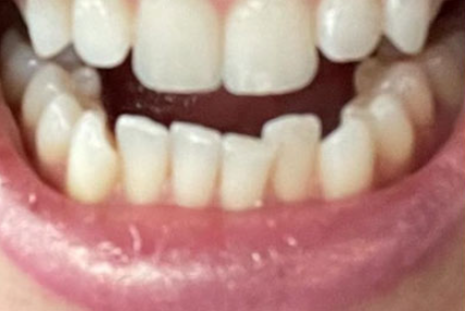 Before Invisalign Teeth Alignment Case 2
